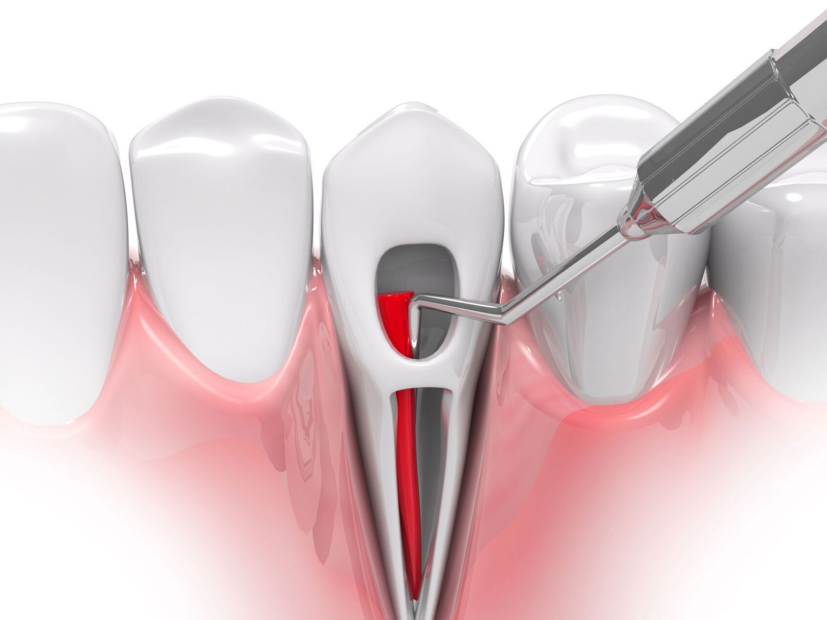 Root Canals